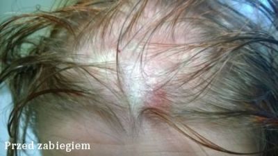 Terapia łysienia - przyczyny łysienia